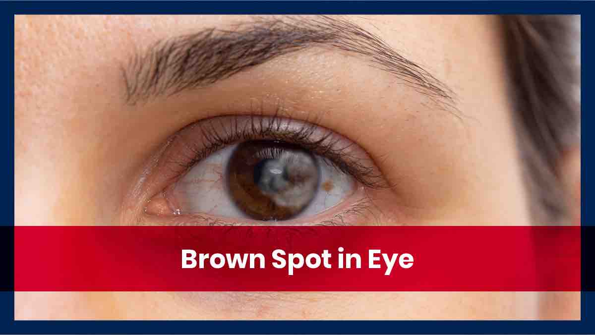 brown spot in eyes